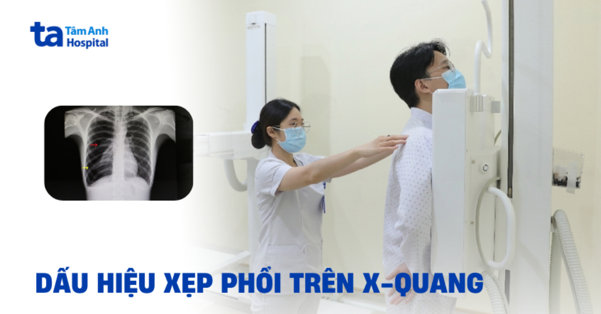 Dấu hiệu xẹp phổi trên X quang