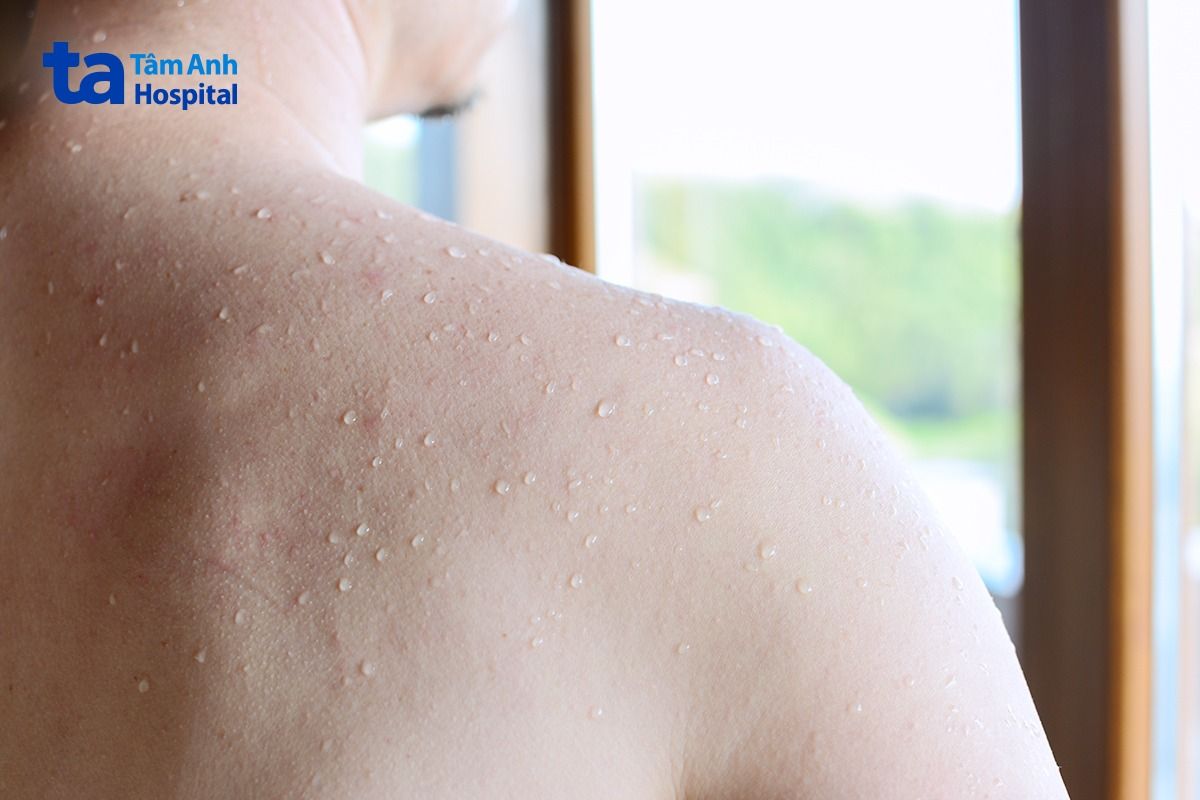 Xông hơi không có tác dụng điều trị virus Dengue